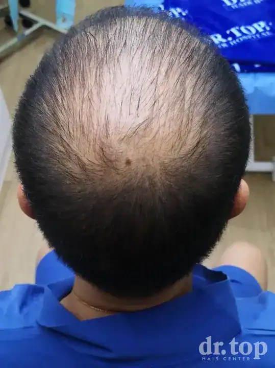 PRP Hair Treatment + Stem Cell Hair Therapy (ALMI) + Combination Treatments before treatment — Dr. Top Hair Hospital