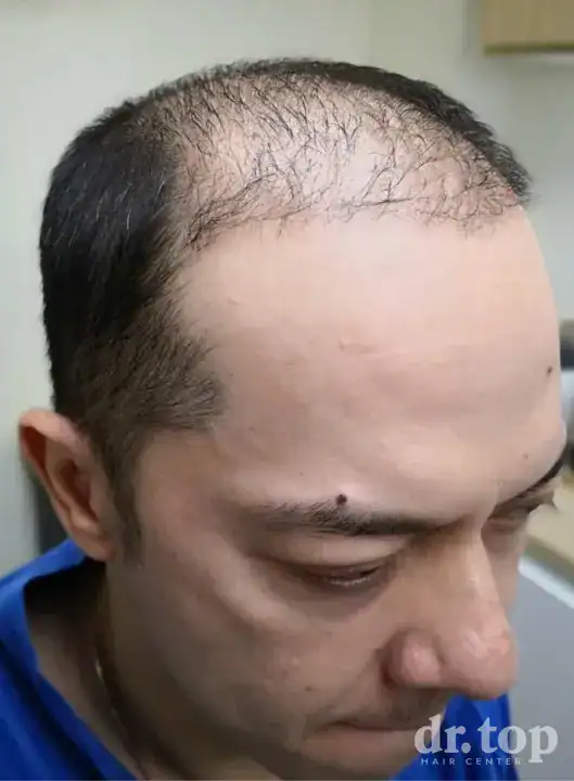 PRP Hair Treatment + Stem Cell Hair Therapy (ALMI) + Combination Treatments before treatment — Dr. Top Hair Hospital