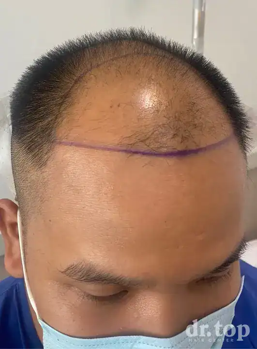 PRP Hair Treatment + Stem Cell Hair Therapy (ALMI) before treatment — Dr. Top Hair Hospital
