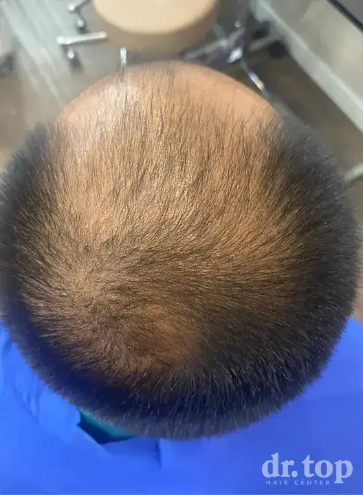 PRP Hair Treatment + Stem Cell Hair Therapy (ALMI) + Combination Treatments before treatment — Dr. Top Hair Hospital