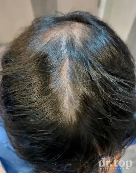 PRP Hair Treatment + Stem Cell Hair Therapy (ALMI) + Combination Treatments before treatment — Dr. Top Hair Hospital