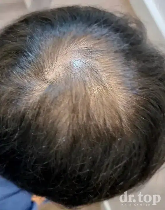 PRP Hair Treatment + Stem Cell Hair Therapy (ALMI) + Combination Treatments before treatment — Dr. Top Hair Hospital