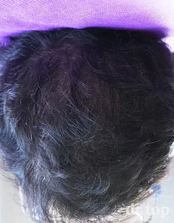 FUI Hair Transplant + PRP Hair Treatment + Stem Cell Hair Therapy (ALMI) + Combination Treatments after treatment — 12 months later — Dr. Top Hair Hospital