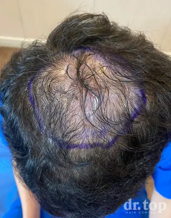 FUI Hair Transplant + PRP Hair Treatment + Stem Cell Hair Therapy (ALMI) + Combination Treatments before treatment — Dr. Top Hair Hospital