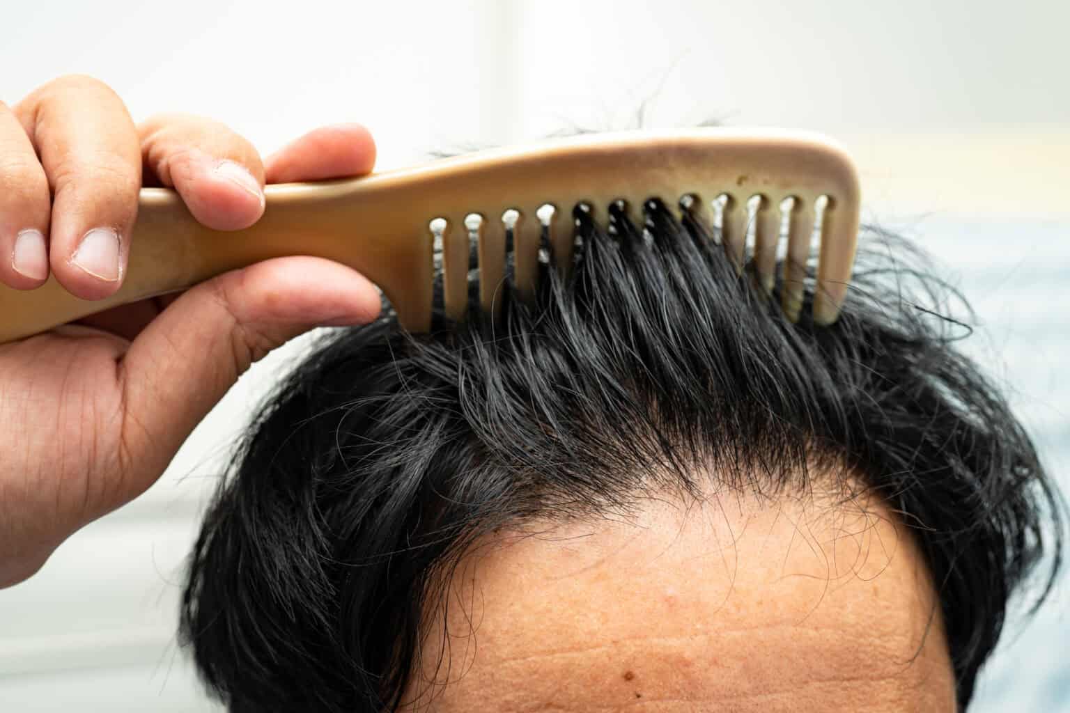 bald at front of head and begin no loss hair glabrous of mature