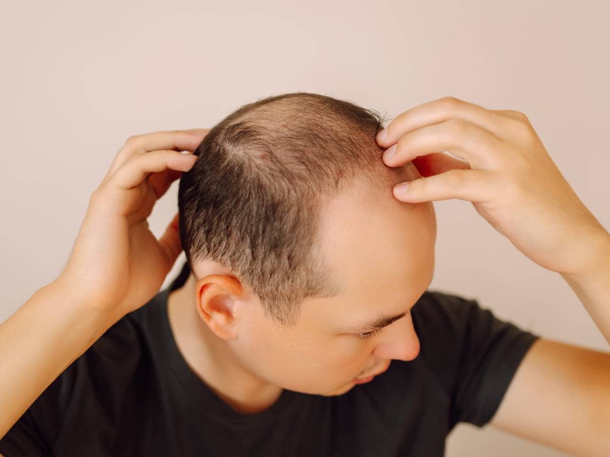 baldness on the head of a middle aged man hair lo 2026 01 09 11 04 24 utc 1920x1228