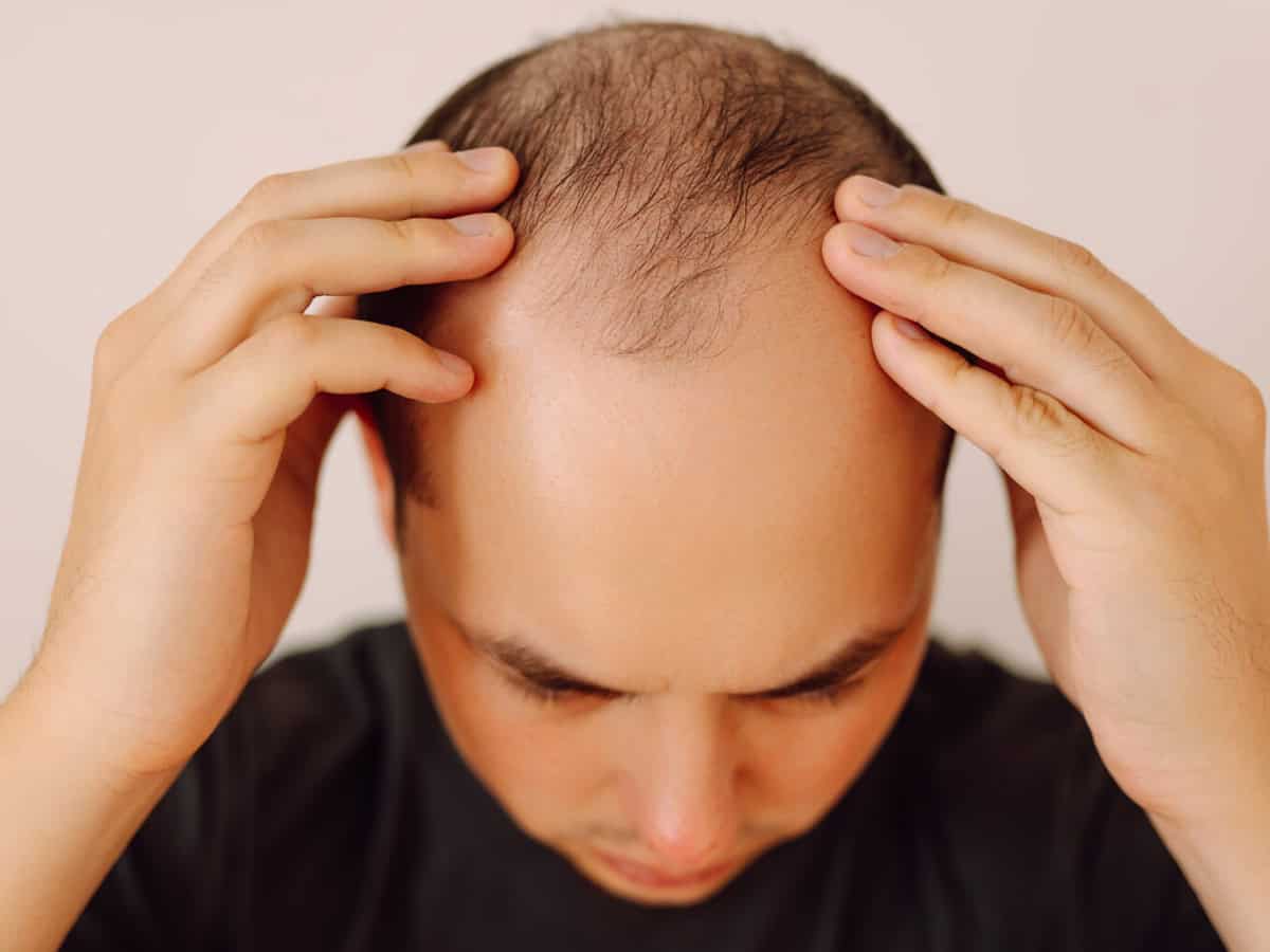 baldness on the head of a middle aged man. hair loss. male hair loss, early baldness and alopecia.