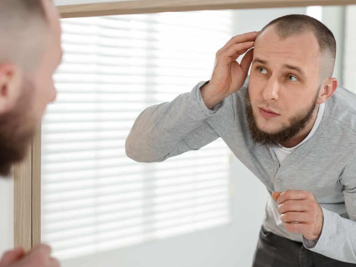 baldness problem. man with receding hairline near mirror at home