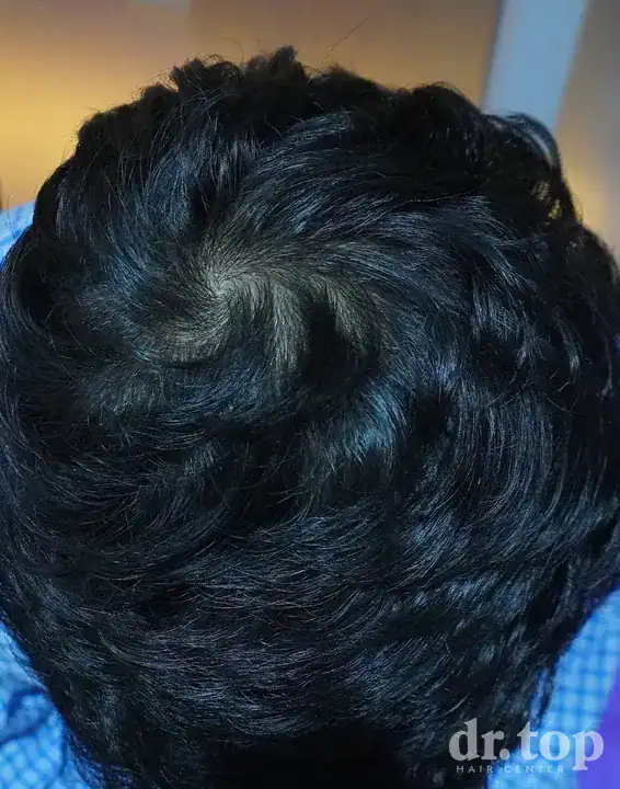 RF Microneedling (FRM) after treatment — 6 months later — Dr. Top Hair Hospital