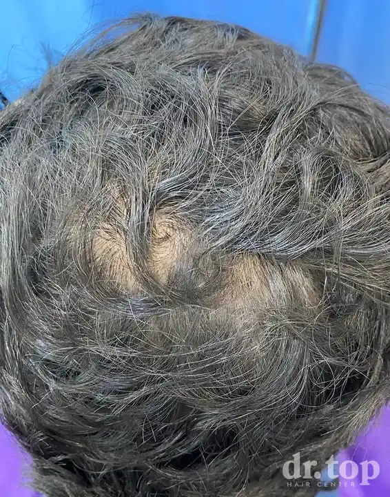 RF Microneedling (FRM) before treatment — Dr. Top Hair Hospital