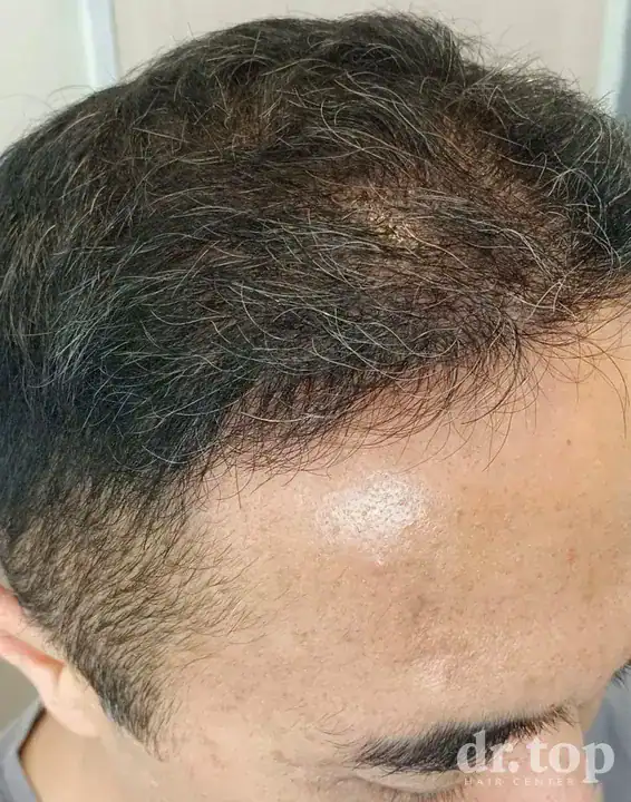 FUE Hair Transplant + DHI Hair Transplant after treatment — 5 months later — Dr. Top Hair Hospital