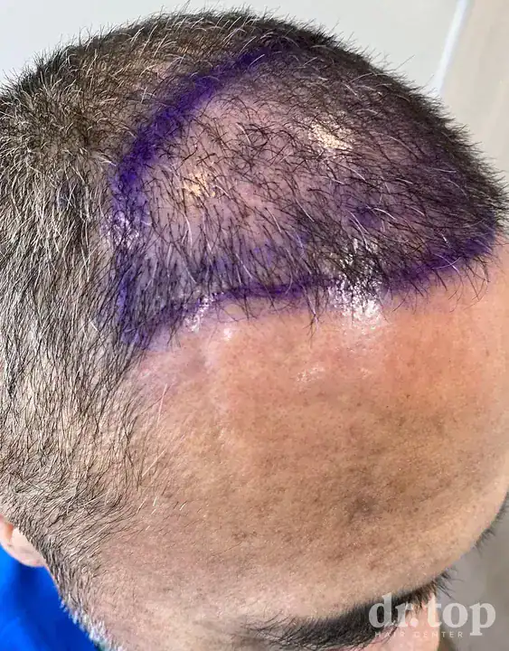 FUE Hair Transplant + DHI Hair Transplant before treatment — Dr. Top Hair Hospital