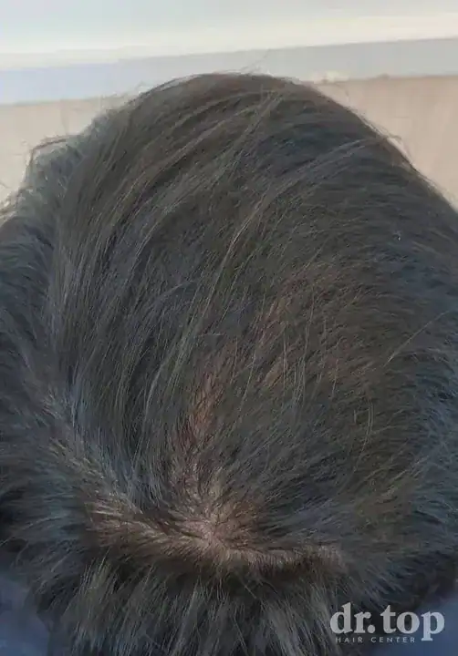 FUE Hair Transplant + DHI Hair Transplant + Combination Treatments after treatment — 5 months later — Dr. Top Hair Hospital