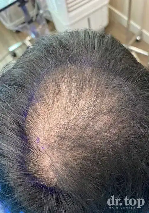 FUE Hair Transplant + DHI Hair Transplant + Combination Treatments before treatment — Dr. Top Hair Hospital