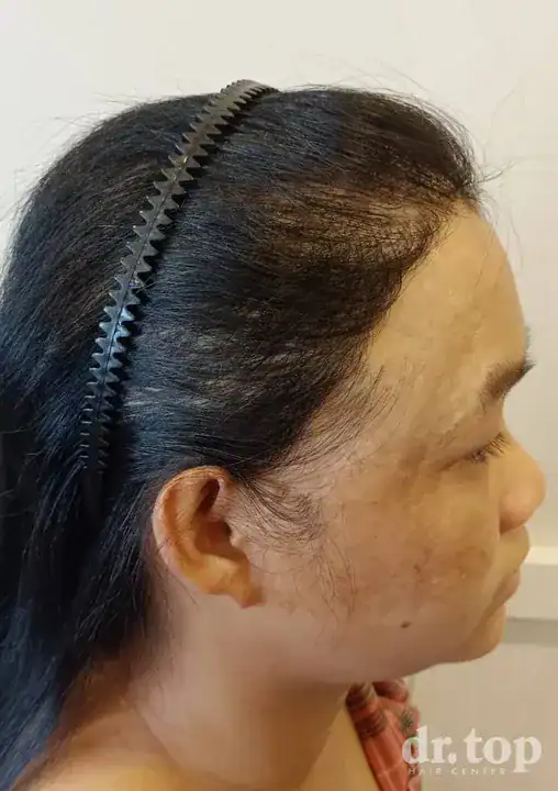 FUE Hair Transplant + DHI Hair Transplant + Combination Treatments + Women's Hair Transplant after treatment — 12 months later — Dr. Top Hair Hospital
