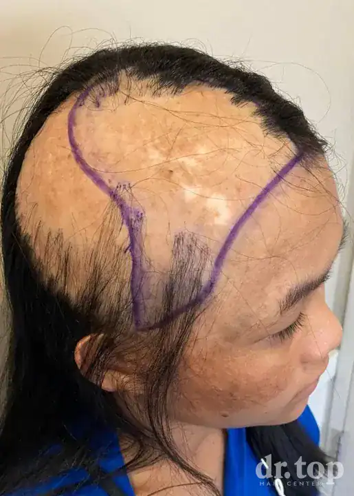 FUE Hair Transplant + DHI Hair Transplant + Combination Treatments + Women's Hair Transplant before treatment — Dr. Top Hair Hospital