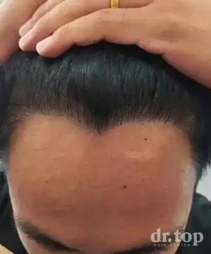 FUE Hair Transplant after treatment — 10 months later — Dr. Top Hair Hospital