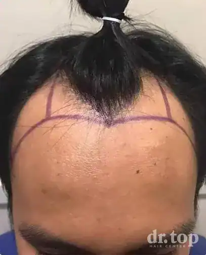 FUE Hair Transplant before treatment — Dr. Top Hair Hospital