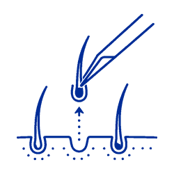 fue hair transplant