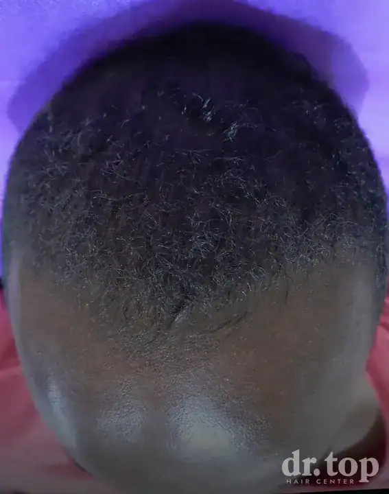 FUI Hair Transplant after treatment — 4 months later — Dr. Top Hair Hospital