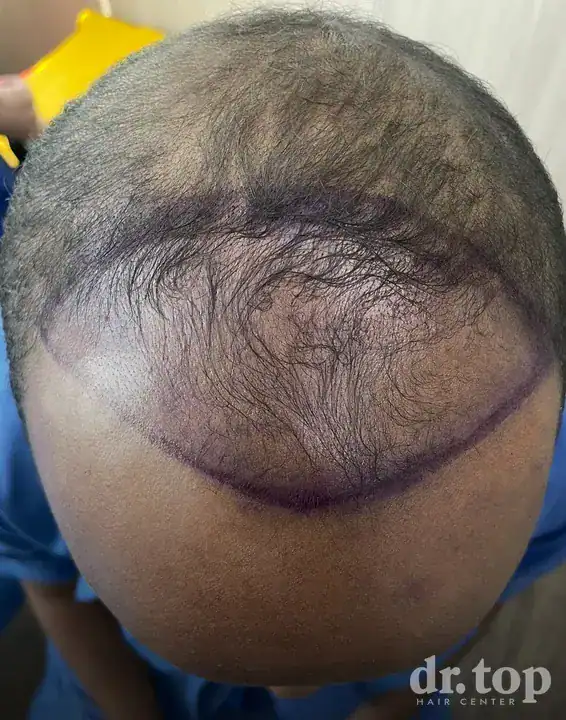 FUI Hair Transplant before treatment — Dr. Top Hair Hospital