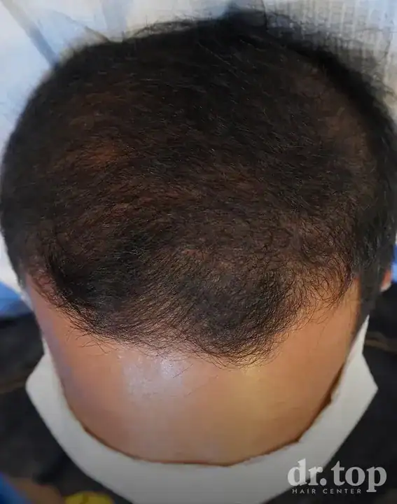 FUI Hair Transplant after treatment — 12 months later — Dr. Top Hair Hospital