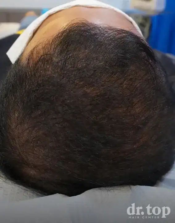 FUI Hair Transplant after treatment — 12 months later — Dr. Top Hair Hospital