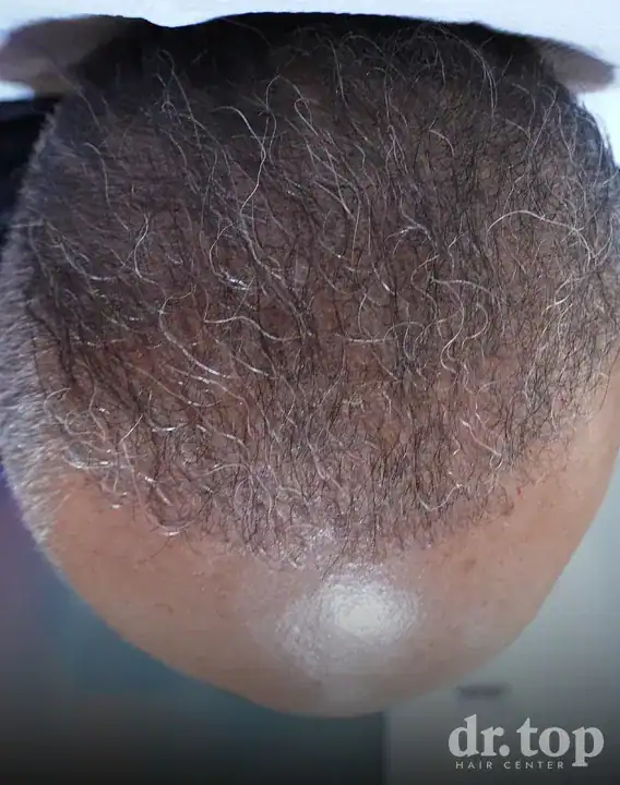 FUI Hair Transplant after treatment — 18 months later — Dr. Top Hair Hospital