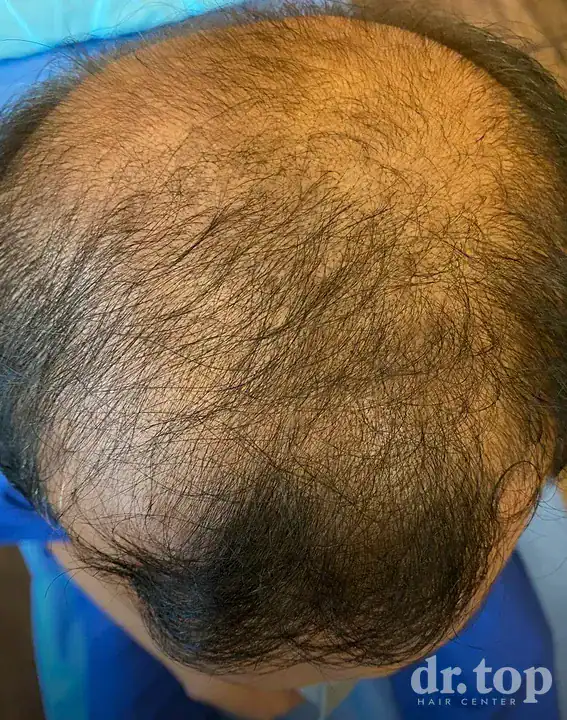 FUI Hair Transplant before treatment — Dr. Top Hair Hospital