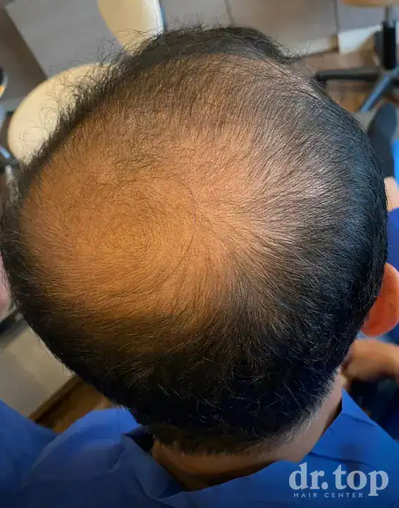 FUI Hair Transplant before treatment — Dr. Top Hair Hospital