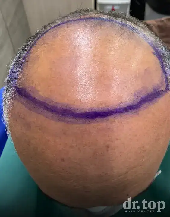 FUI Hair Transplant before treatment — Dr. Top Hair Hospital
