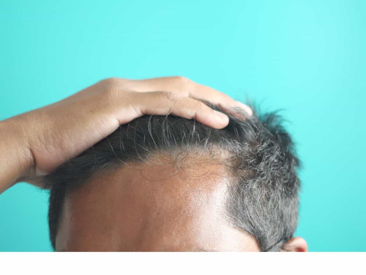 hair loss concept with man checking his hair