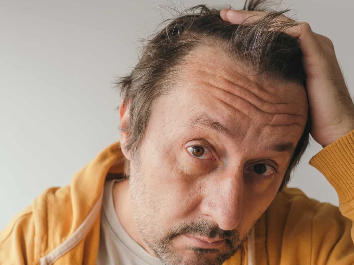 hair loss, man looking at the mirror concerned about losing his