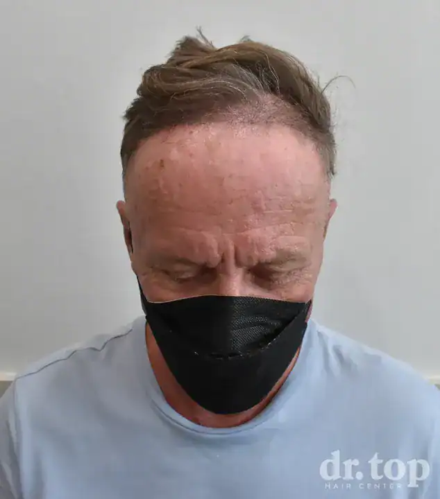 FUI Hair Transplant after treatment — 6 months later — Dr. Top Hair Hospital