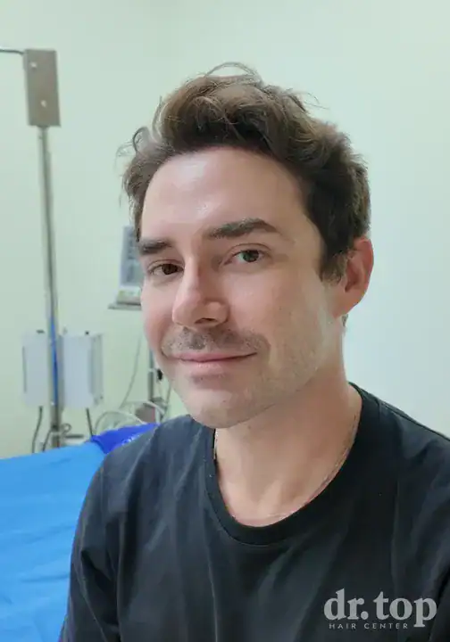 FUI Hair Transplant after treatment — 6 months later — Dr. Top Hair Hospital