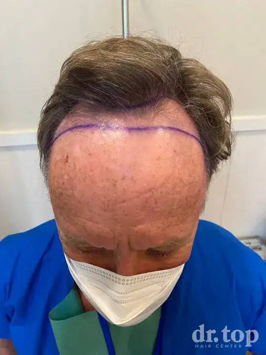 FUI Hair Transplant before treatment — Dr. Top Hair Hospital