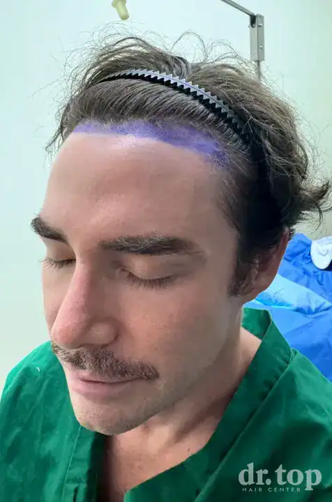 FUI Hair Transplant before treatment — Dr. Top Hair Hospital