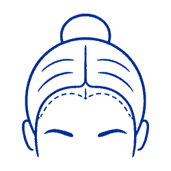 hair transplant for women
