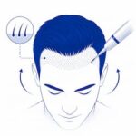 hair transplant procedure illustration