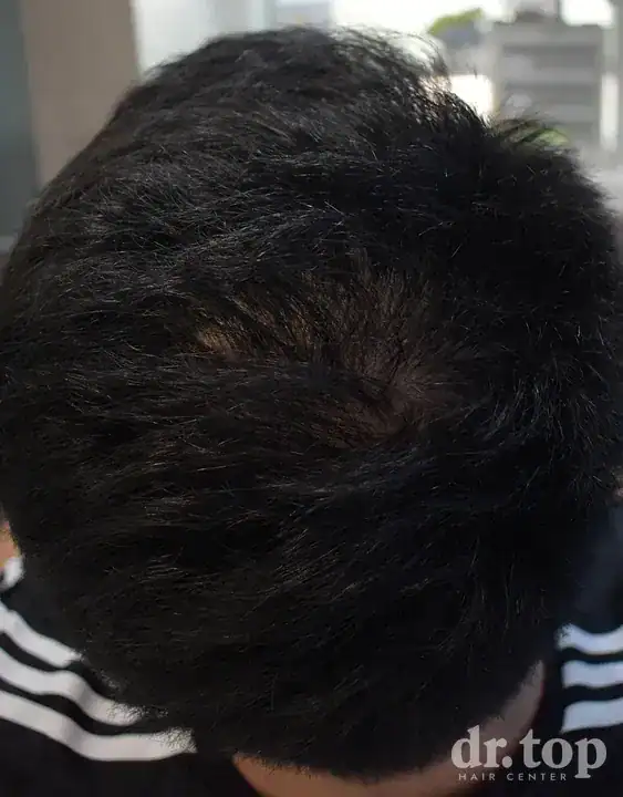 Long Hair FUI after treatment — 12 months later — Dr. Top Hair Hospital