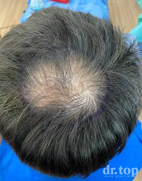 Long Hair FUI before treatment — Dr. Top Hair Hospital