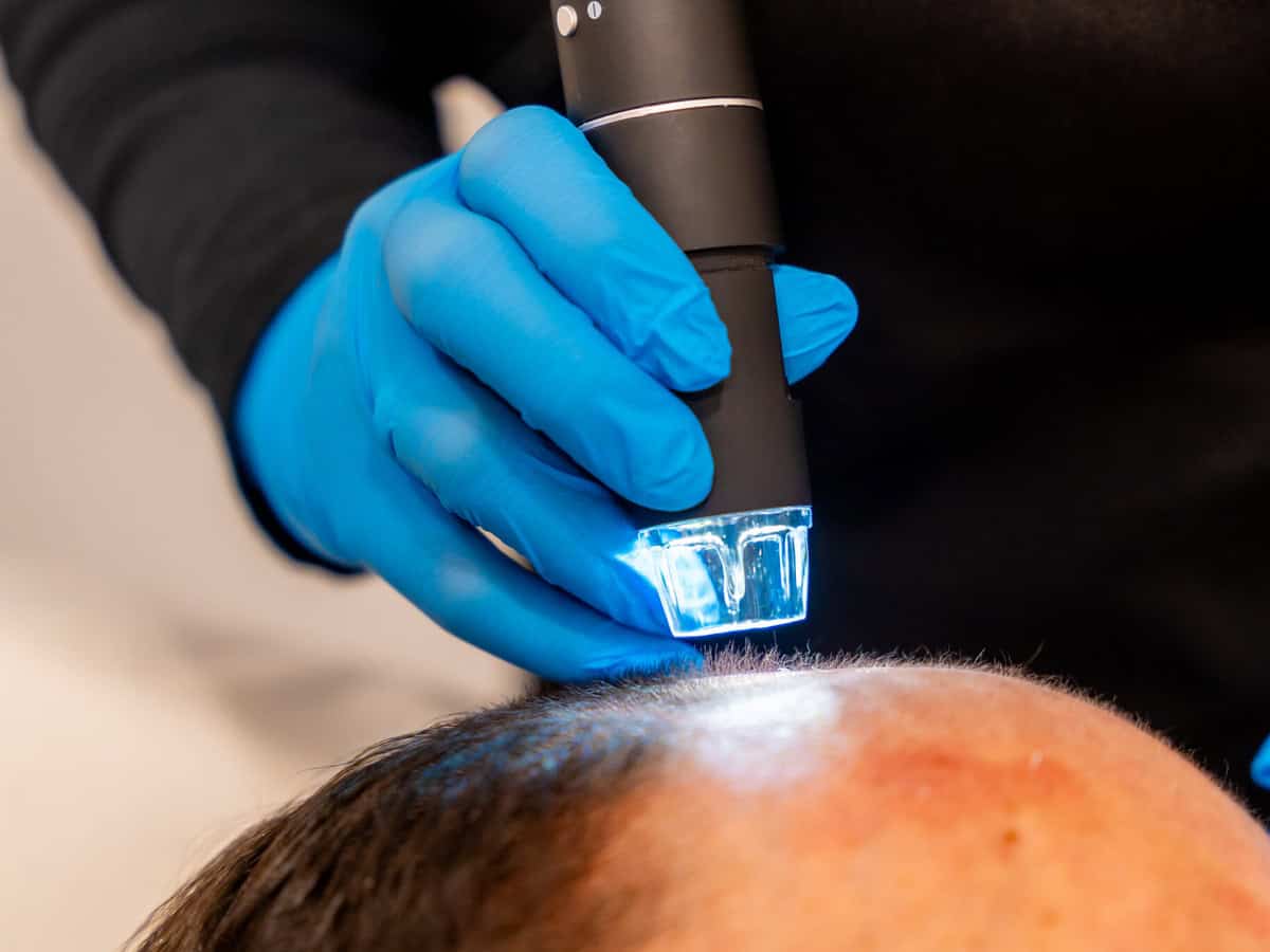 man at the spa getting an baldness treatment with laser