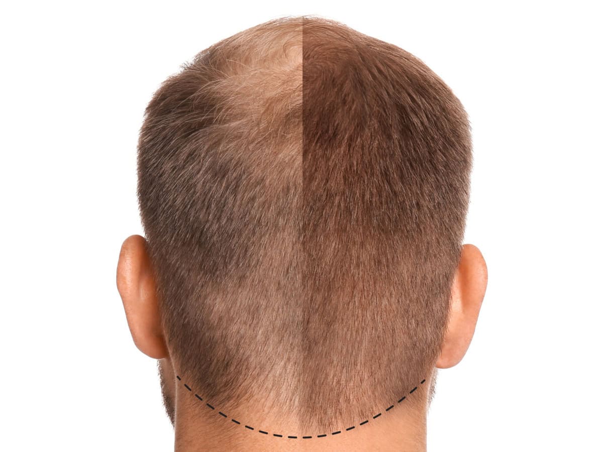 Your Complete Thailand Hair Transplant Guide to Fuller Hair man suffering from baldness on white background b 2026 01 07 06 40 19 utc 1920x1535