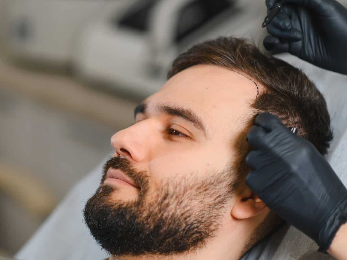 man undergoing hair transplant procedure marking receding hairline