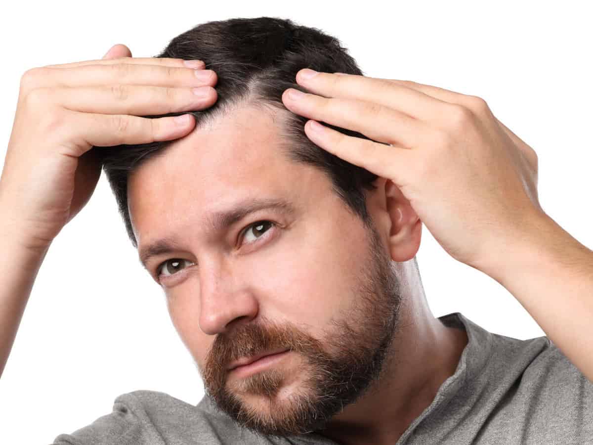 man with hair loss problem on white background
