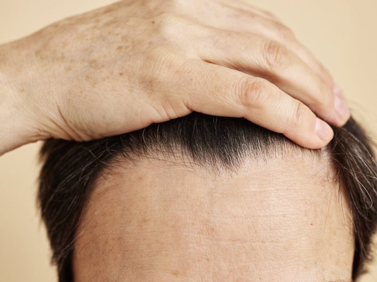 receding hairline close up