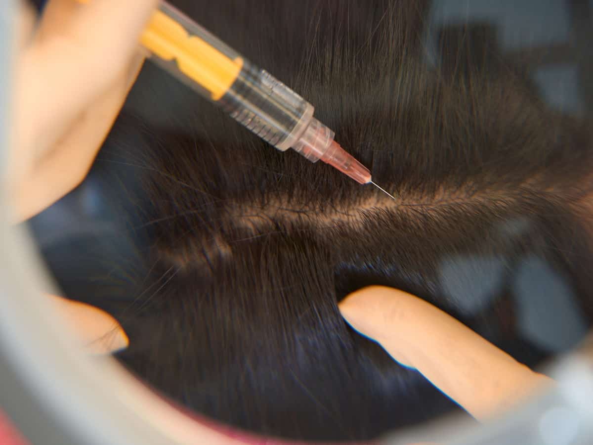 scalp injection procedure for hair growth 2026 03 19 21 36 53 utc