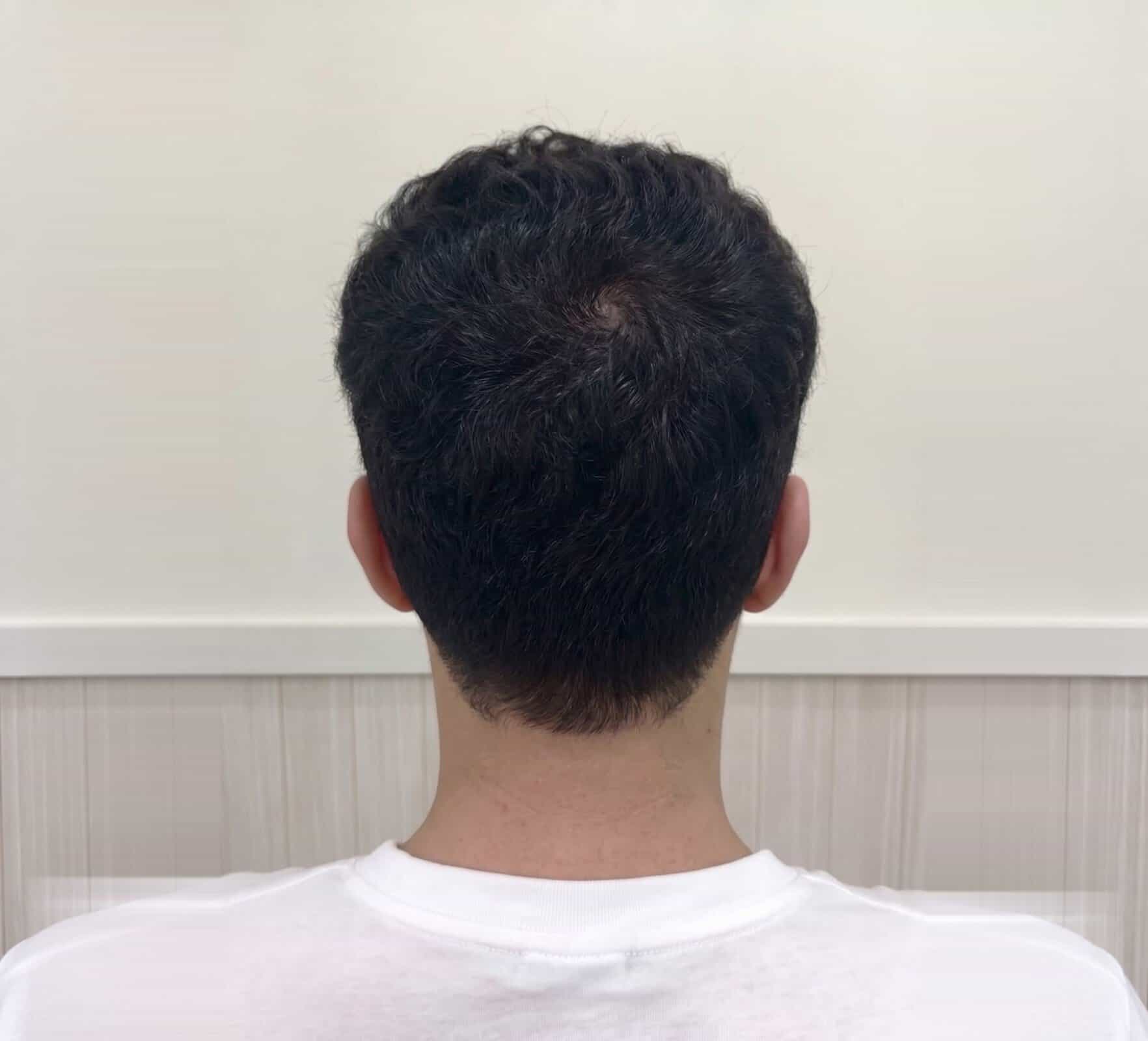 Rear view of the unshaven donor area five days after hair transplant treatment