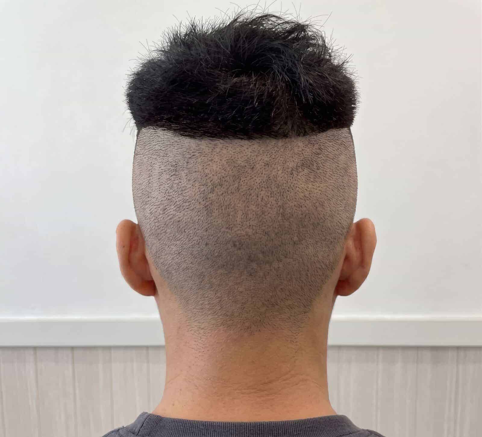 Rear view of a shaved donor area with longer hair retained above it