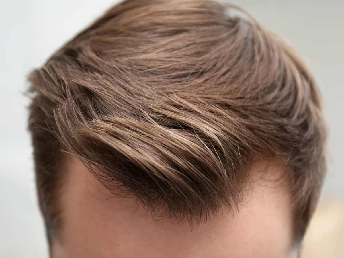 Your Complete Thailand Hair Transplant Guide to Fuller Hair young man with hair loss problem indoors, closeup